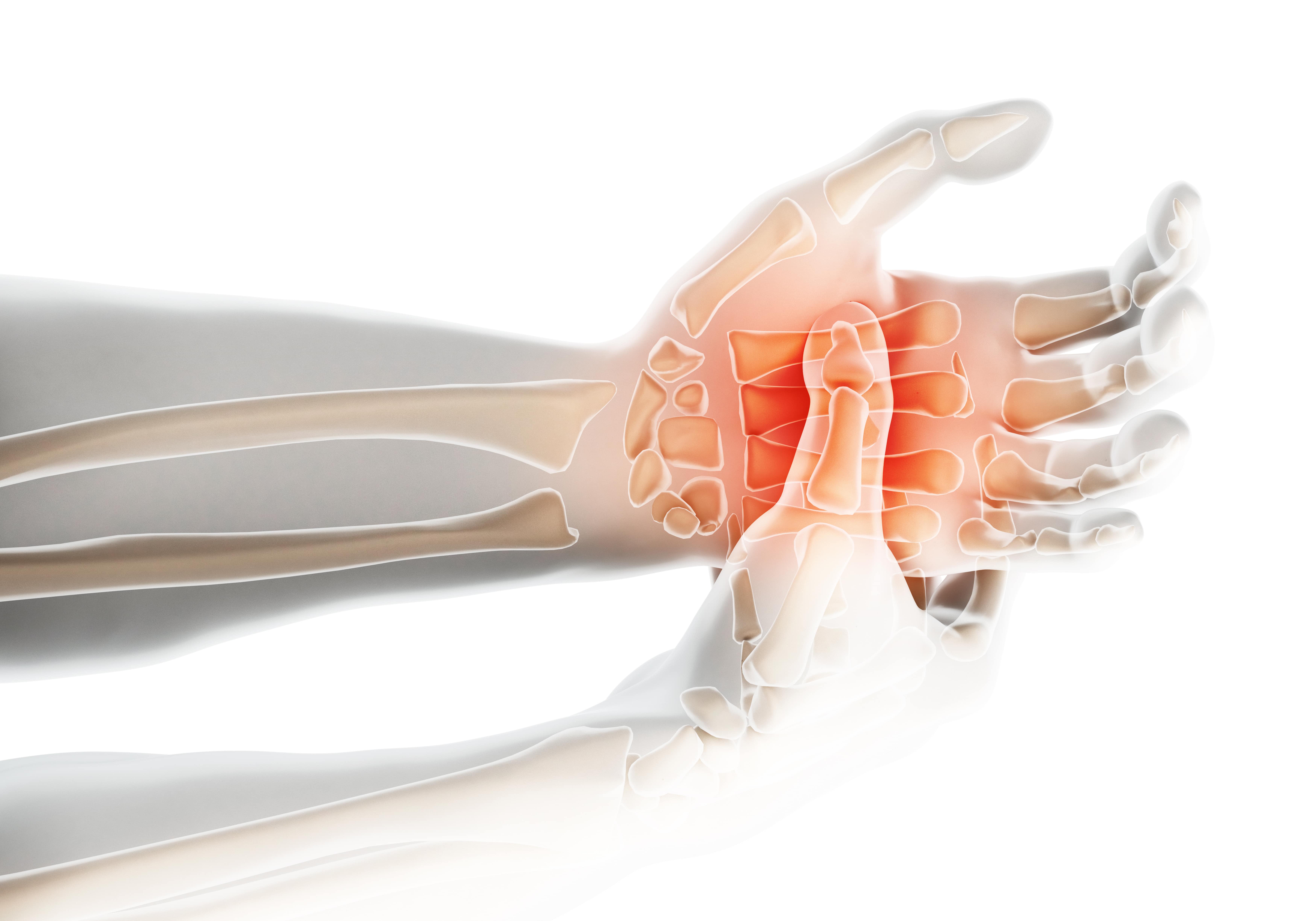 Arthrite de la main : 10 façons naturelles de soulager les ...